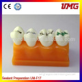 Sealant and inlay dental demonstration model/clinic education models